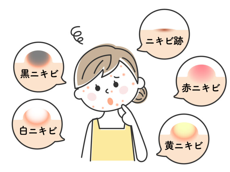 ニキビにパッチが効果的？その理由と賢い使い方！